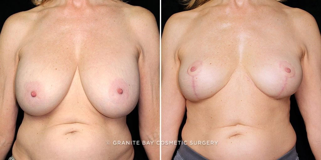 Breast Implant Removal