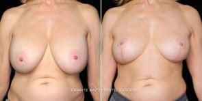 breast-lift-with-implant-removal-20887a-gbc
