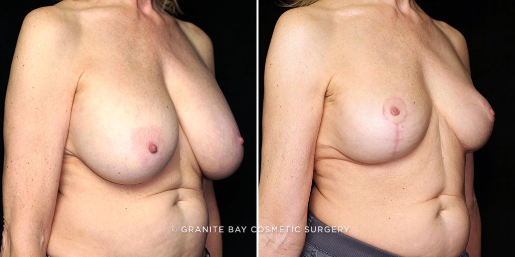 breast-lift-with-implant-removal-20887b-gbc