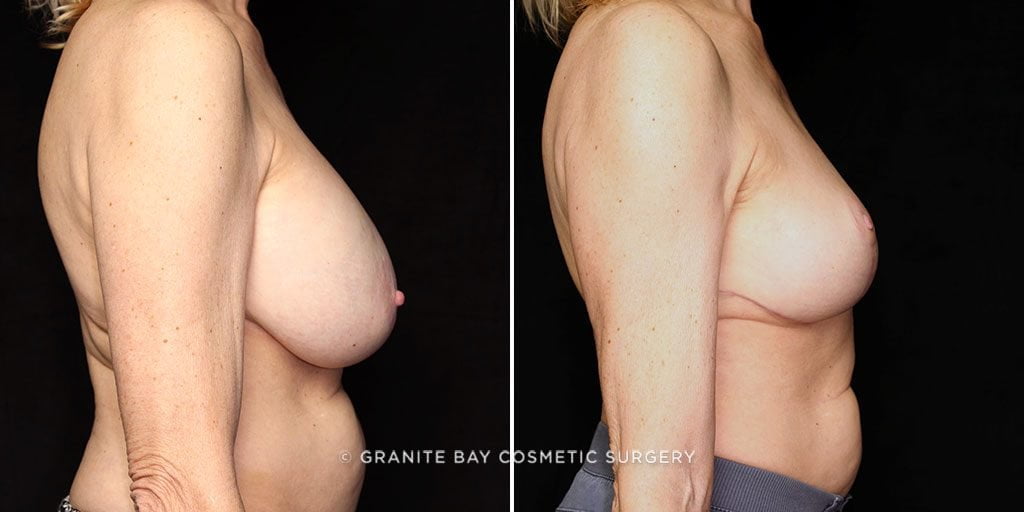 breast-lift-with-implant-removal-20887c-gbc