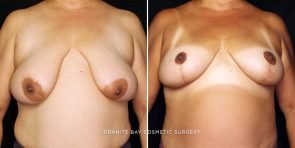 breast-lift-with-implants-22871a-gbc