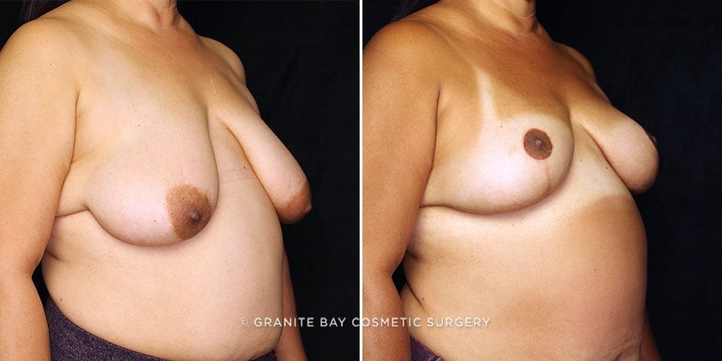 breast-lift-with-implants-22871b-gbc