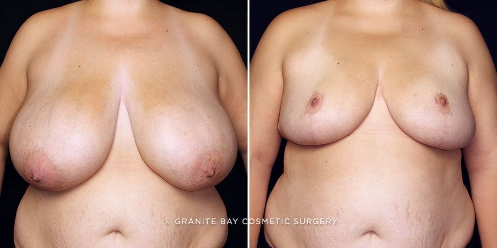 Breast Reduction