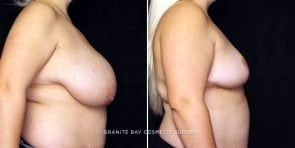 breast-reduction-22089c-gbc