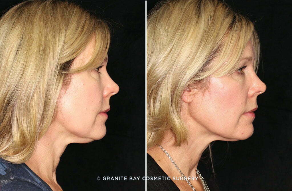 Coolsculpting of the Neck