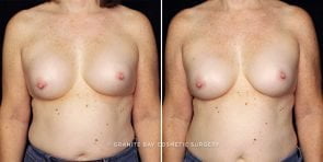 breast-implant-exchange-22906a-gbc
