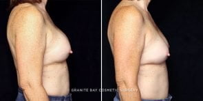breast-implant-exchange-22906c-gbc