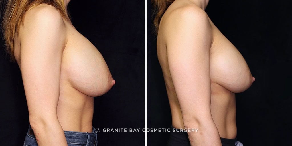 breast-implant-exchange-downsize-17776c-gbc