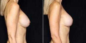 breast-implant-exchange-downsize-22533c-gbc