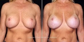 breast-implant-exchange-update-22274a-gbc