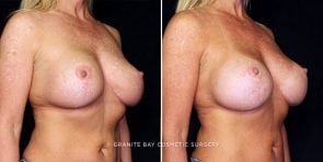 breast-implant-exchange-update-22274b-gbc