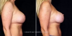 breast-implant-exchange-update-22274c-gbc
