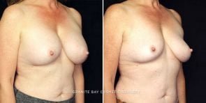 breast-implant-removal-14356b-gbc