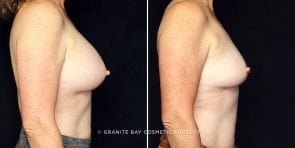 breast-implant-removal-14356c-gbc