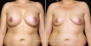 breast-implant-removal-23118a-gbc