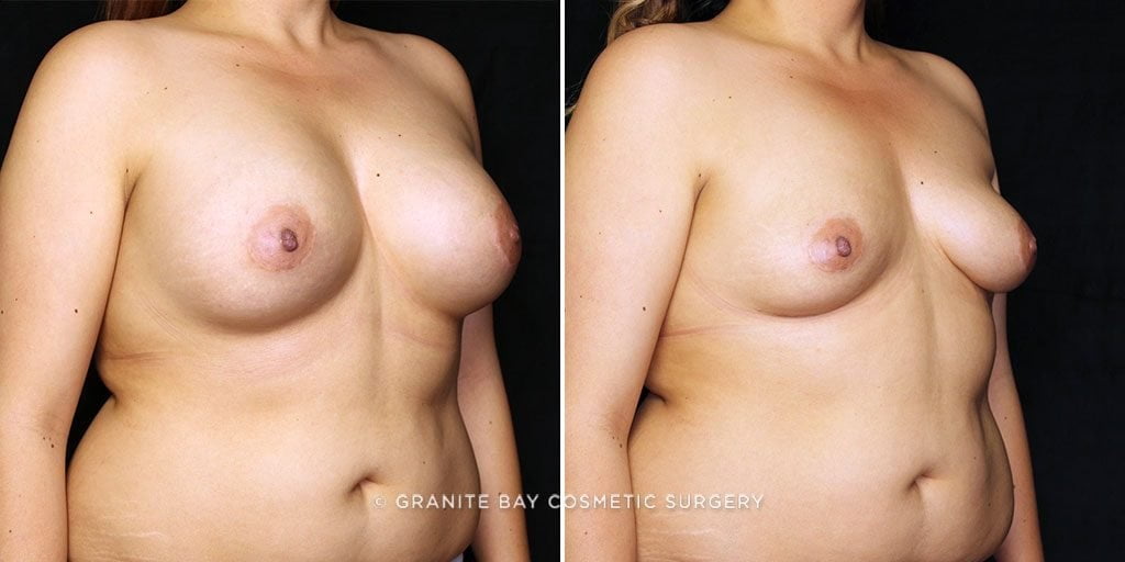 breast-implant-removal-23118b-gbc