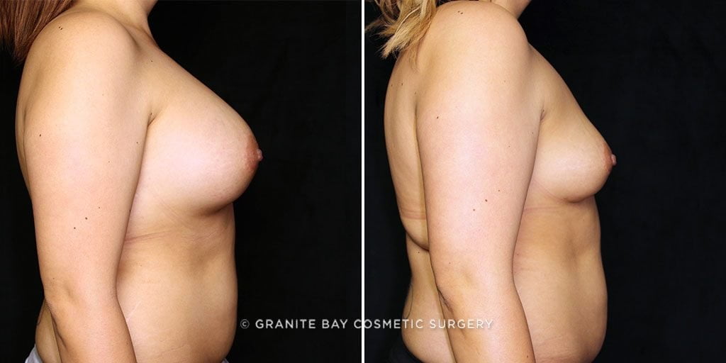 breast-implant-removal-23118c-gbc