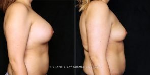 breast-implant-removal-23118c-gbc