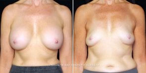 breast-implant-removal-23216a-gbc
