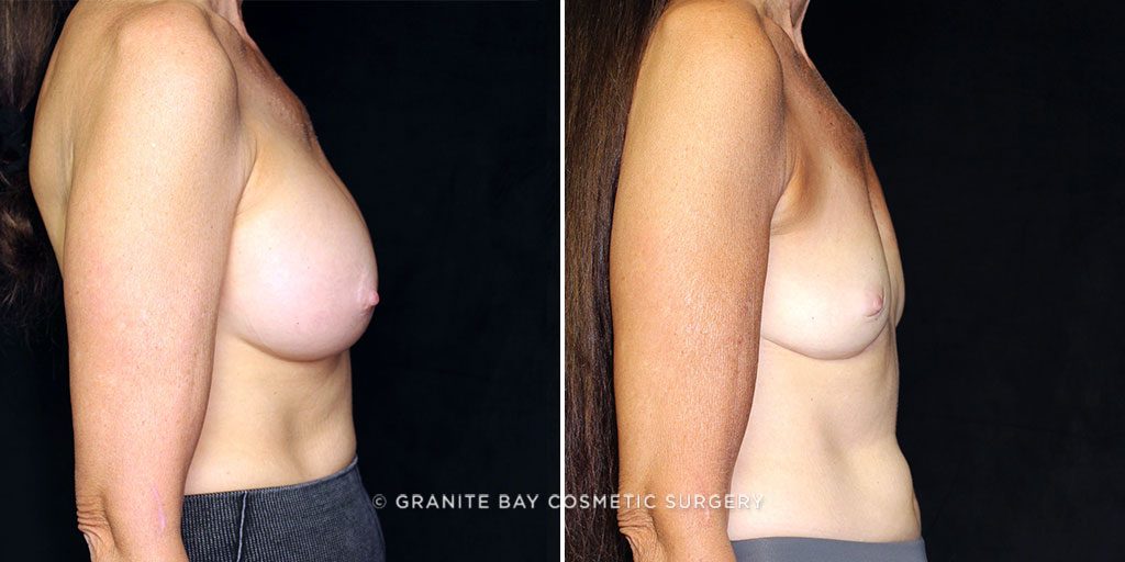 breast-implant-removal-23216c-gbc