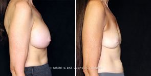 breast-implant-removal-23216c-gbc