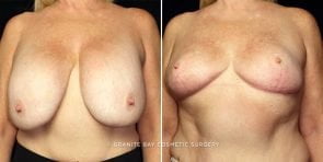 breast-implant-removal-23594a-gbc