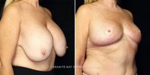 breast-implant-removal-23594b-gbc