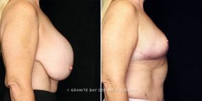 breast-implant-removal-23594c-gbc