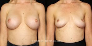 breast-implant-removal-3215a-gbc