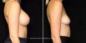 breast-implant-removal-3215c-gbc