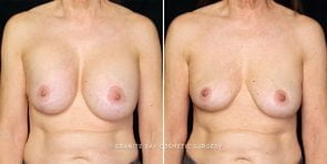 breast-implant-removal-4524a-gbc