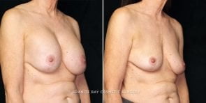 breast-implant-removal-4524b-gbc