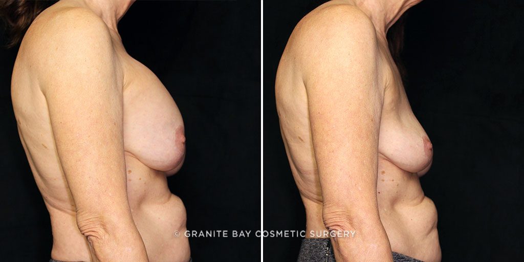 breast-implant-removal-4524c-gbc