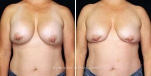 breast-implant-removal-7818a-gbc
