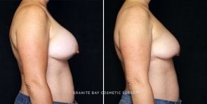 breast-implant-removal-7818c-gbc