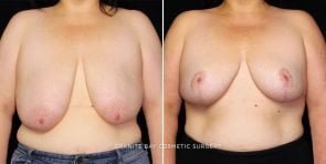 breast-lift-with-auto-aug-22789a-gbc