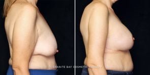 breast-lift-with-implants-23566c-gbc