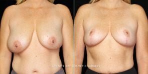 breast-reduction-21612a-gbc