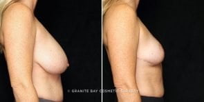 breast-reduction-21612c-gbc