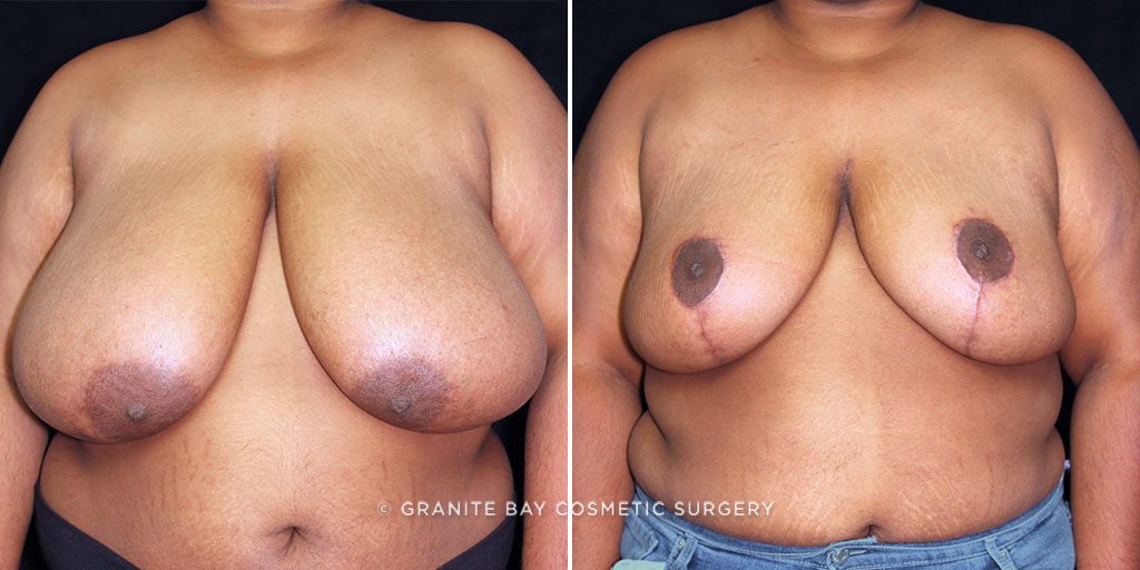 Breast Reduction