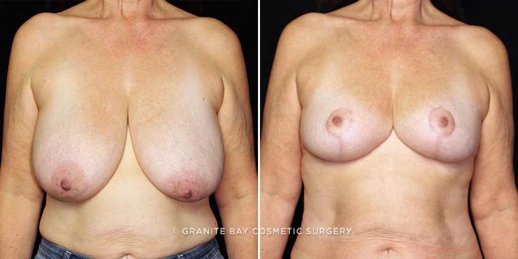 Breast Reduction