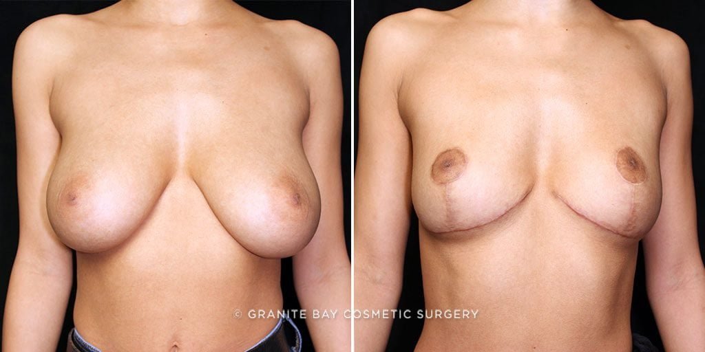 Breast Reduction