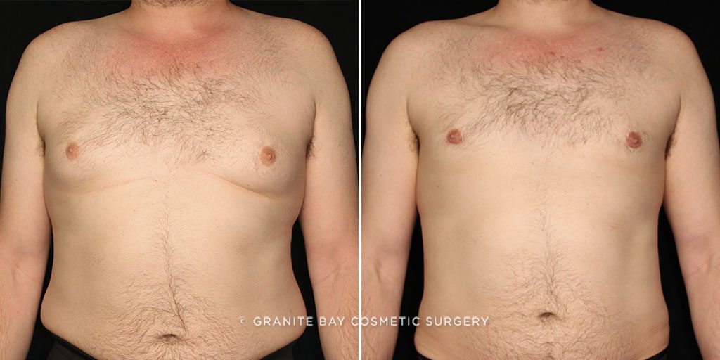 Male Breast Reduction