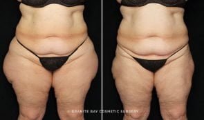 liposuction-outer-thighs-22510a-gbc