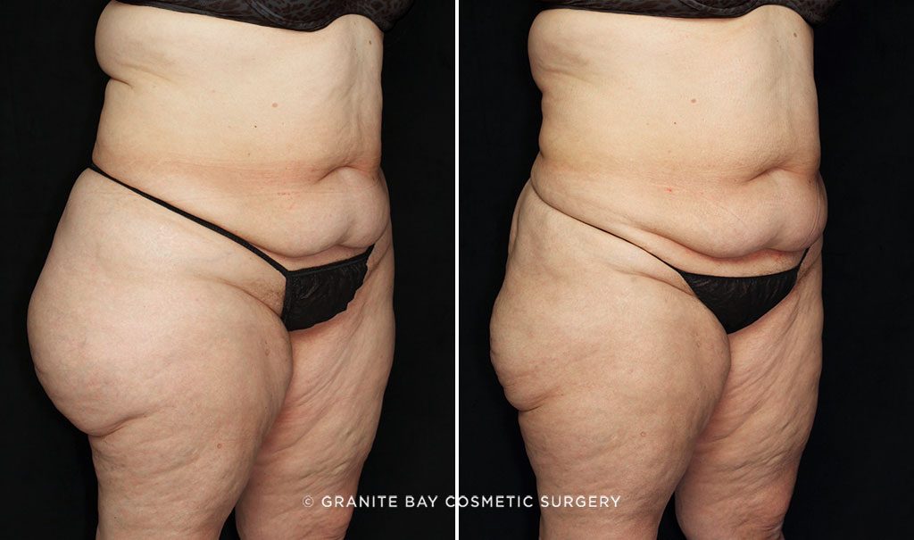 liposuction-outer-thighs-22510b-gbc