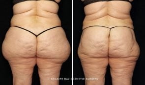 liposuction-outer-thighs-22510d-gbc