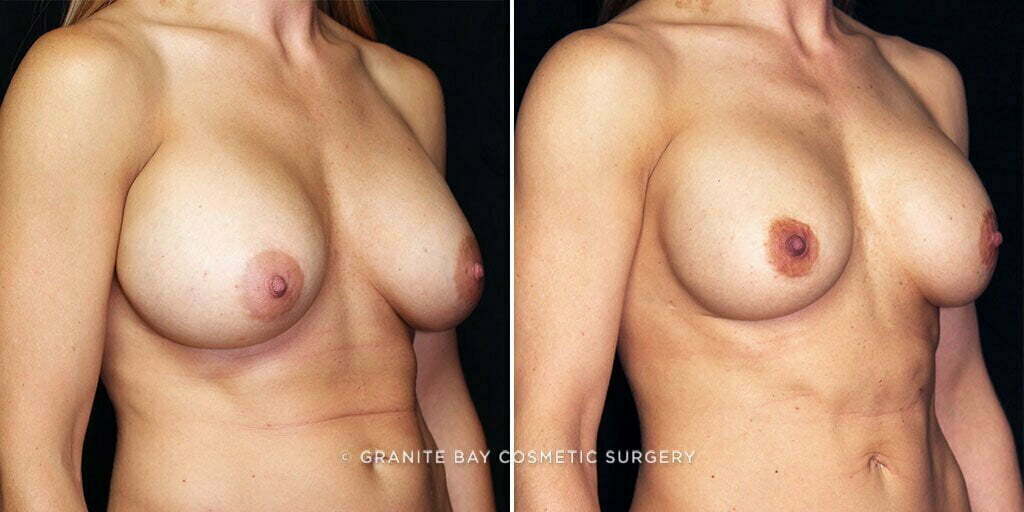 breast-implant-exchange-22872b-gbc