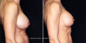 breast-implant-exchange-22872c-gbc