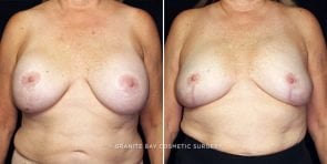 breast-implant-exchange-23359a-gbc