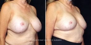 breast-implant-exchange-23359b-gbc